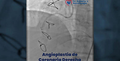 Cateterismo + Angioplastia Coronaria